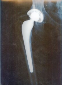 My right hip replacement